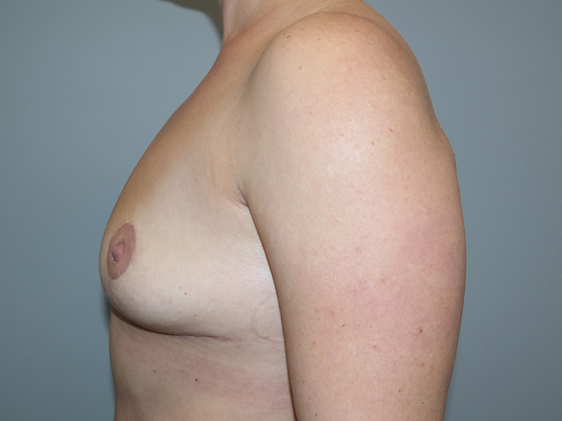 Breast Lift Before and After 03 | Sanjay Grover MD FACS