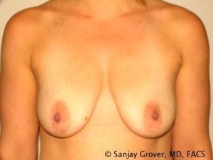Breast Lift Before and After 41 | Sanjay Grover MD FACS