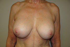 Breast Lift Before and After 32 | Sanjay Grover MD FACS