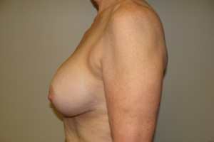 Breast Lift Before and After 32 | Sanjay Grover MD FACS