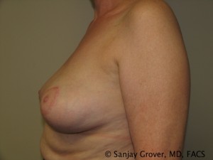 Breast Reduction Before and After 10 | Sanjay Grover MD FACS