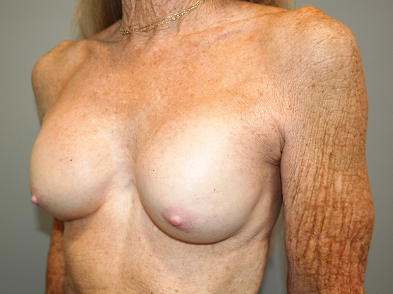 Breast Revision Before and After 06 | Sanjay Grover MD FACS