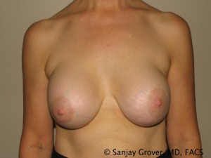Breast Revision Before and After 33 | Sanjay Grover MD FACS