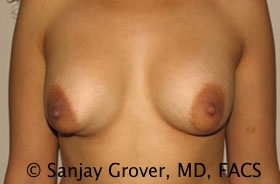Breast Revision Before and After 47 | Sanjay Grover MD FACS