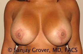 Breast Revision Before and After 35 | Sanjay Grover MD FACS