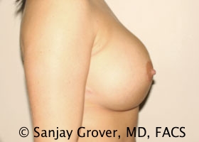 Breast Revision Before and After 37 | Sanjay Grover MD FACS