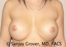 Breast Revision Before and After 24 | Sanjay Grover MD FACS