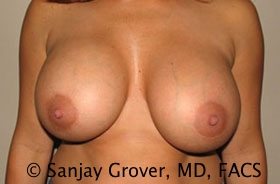 Breast Revision Before and After 27 | Sanjay Grover MD FACS