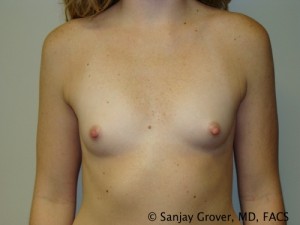 Mini Breast Augmentation Before and After 03 | Sanjay Grover MD FACS