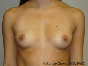 Mini Breast Augmentation Before and After 10 | Sanjay Grover MD FACS