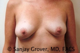 Mini Breast Lift Before and After 01 | Sanjay Grover MD FACS
