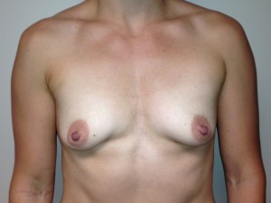 Mini Breast Lift Before and After 01 | Sanjay Grover MD FACS