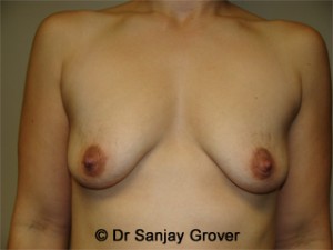 Mini Breast Lift Before and After 09 | Sanjay Grover MD FACS