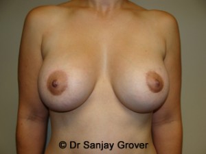 Mini Breast Lift Before and After 21 | Sanjay Grover MD FACS