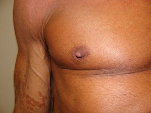 Nipple Reduction Before and After 09 | Sanjay Grover MD FACS