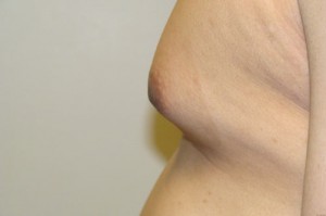 Nipple Reduction Before and After 13 | Sanjay Grover MD FACS