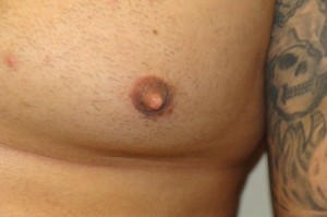 Nipple Reduction Before and After 14 | Sanjay Grover MD FACS