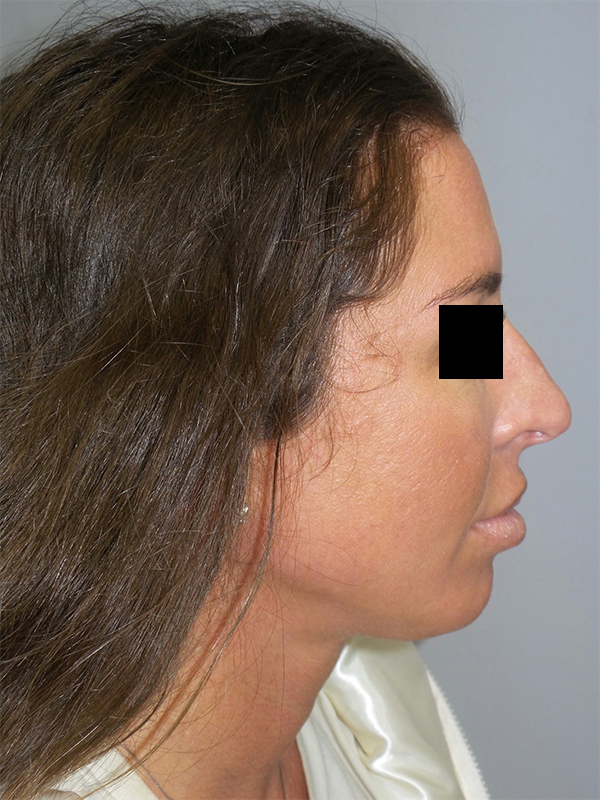 Chin Augmentation Before and After 05 | Sanjay Grover MD FACS