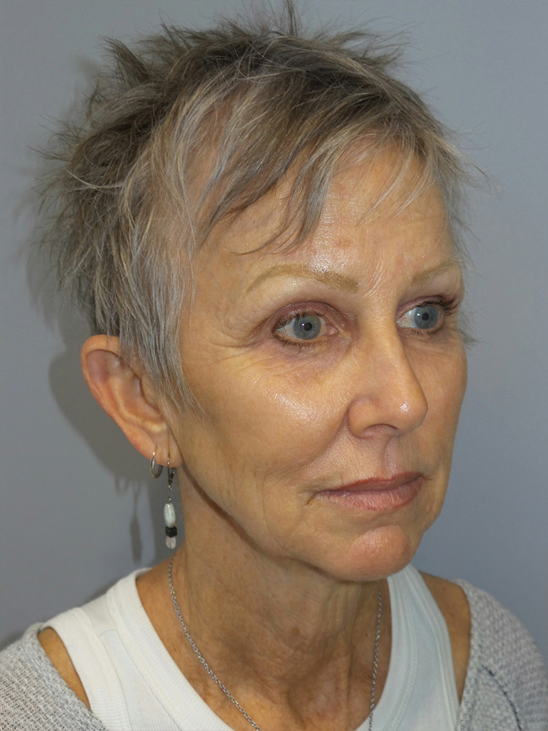 Facelift Before and After 09 | Sanjay Grover MD FACS