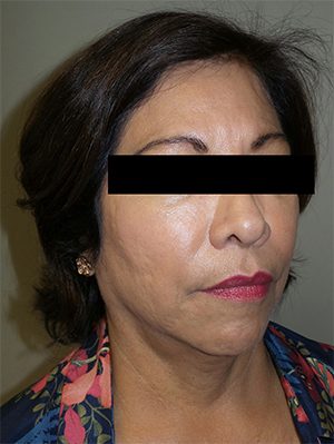 Facelift Before and After 25 | Sanjay Grover MD FACS