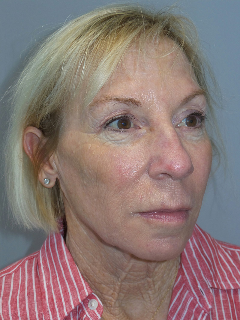 Facelift Before and After 27 | Sanjay Grover MD FACS