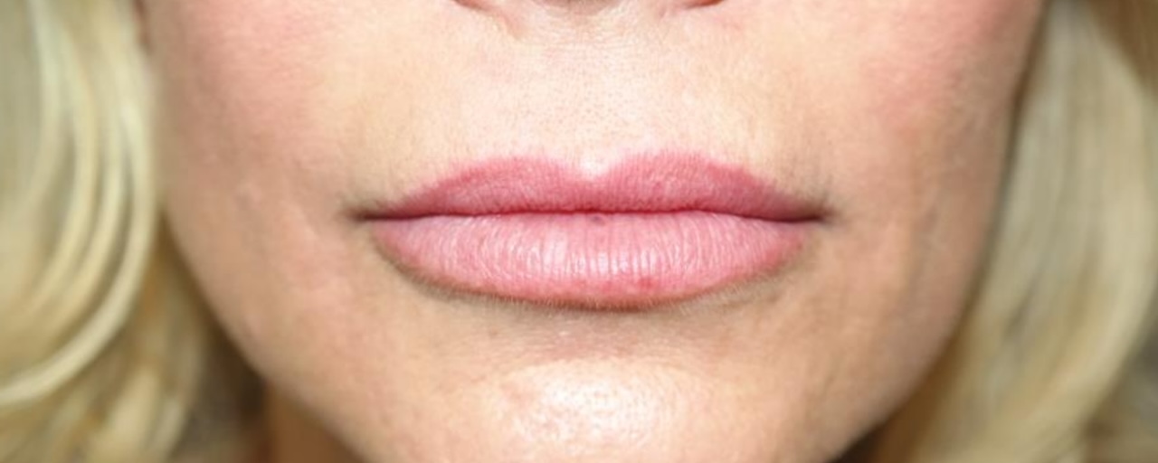 Lip Lift Before and After 05 | Sanjay Grover MD FACS
