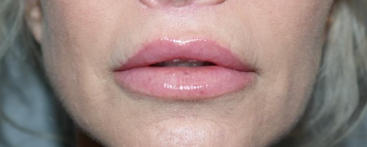 Lip Lift Before and After 02 | Sanjay Grover MD FACS
