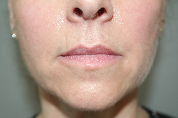 Lip Lift Before and After 05 | Sanjay Grover MD FACS