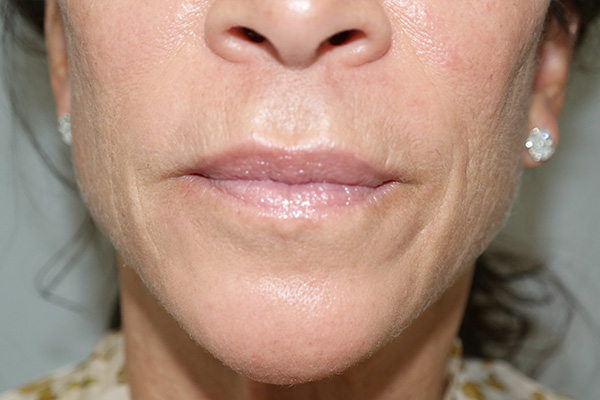 Lip Lift Before and After 06 | Sanjay Grover MD FACS