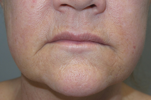 Lip Lift Before and After 06 | Sanjay Grover MD FACS
