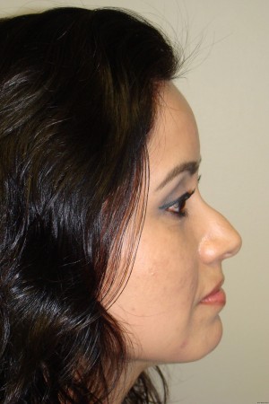 Rhinoplasty Before and After 15 | Sanjay Grover MD FACS