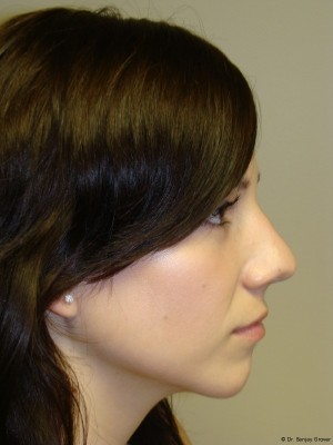 Rhinoplasty Before and After 28 | Sanjay Grover MD FACS