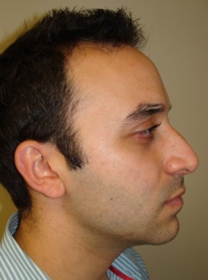 Rhinoplasty Before and After 04 | Sanjay Grover MD FACS