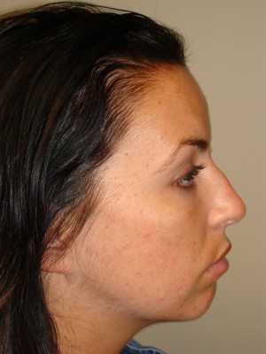 Rhinoplasty Before and After 12 | Sanjay Grover MD FACS