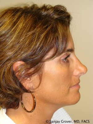 Rhinoplasty Before and After 43 | Sanjay Grover MD FACS