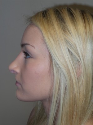 Rhinoplasty Before and After 27 | Sanjay Grover MD FACS