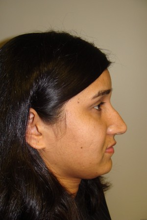 Rhinoplasty Before and After 08 | Sanjay Grover MD FACS