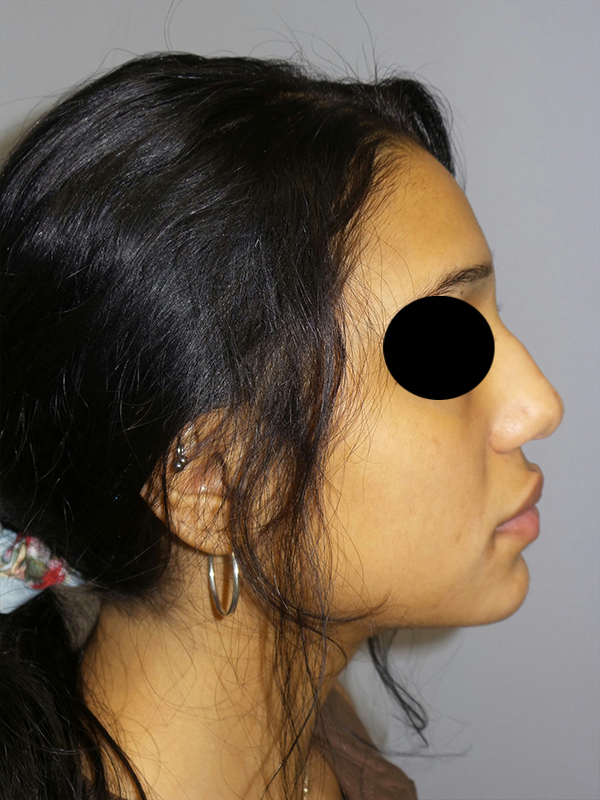 Rhinoplasty Before and After 44 | Sanjay Grover MD FACS