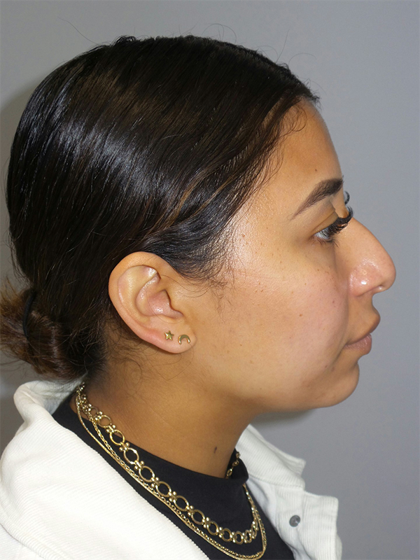 Rhinoplasty Before and After 43 | Sanjay Grover MD FACS