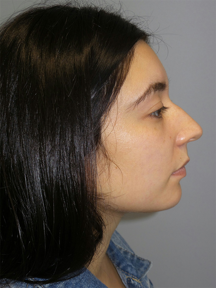 Rhinoplasty Before and After 28 | Sanjay Grover MD FACS