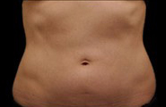 Coolsculpting Before and After 08 | Sanjay Grover MD FACS