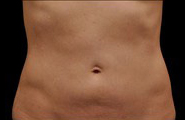 Coolsculpting Before and After | Sanjay Grover MD FACS