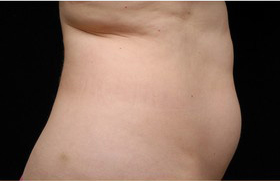 Coolsculpting Before and After 22 | Sanjay Grover MD FACS