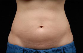 Coolsculpting Before and After 24 | Sanjay Grover MD FACS