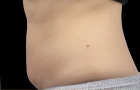 Coolsculpting Before and After 19 | Sanjay Grover MD FACS