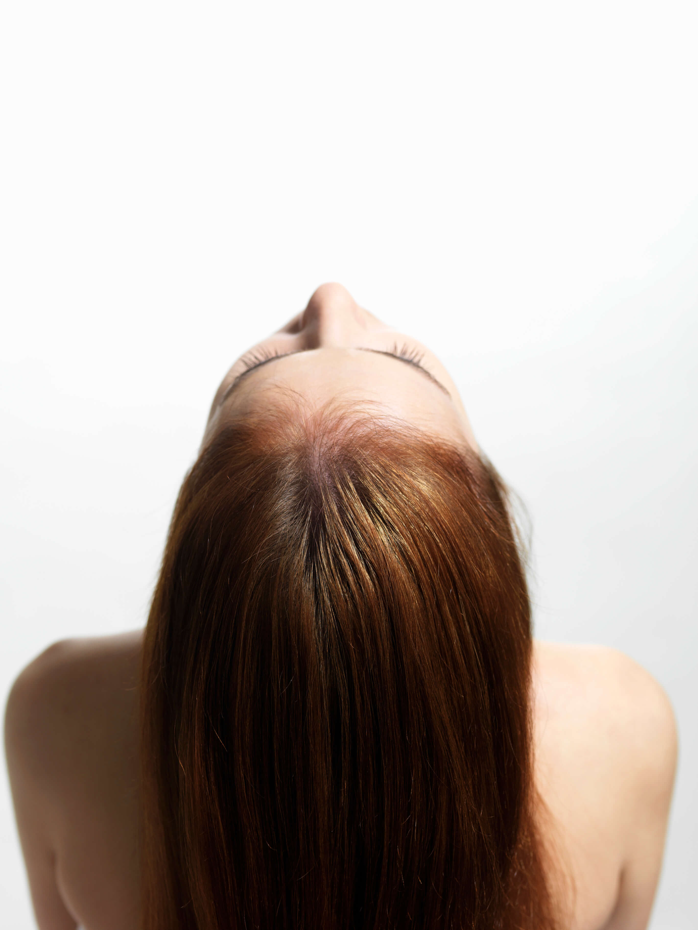 Hairline Lowering