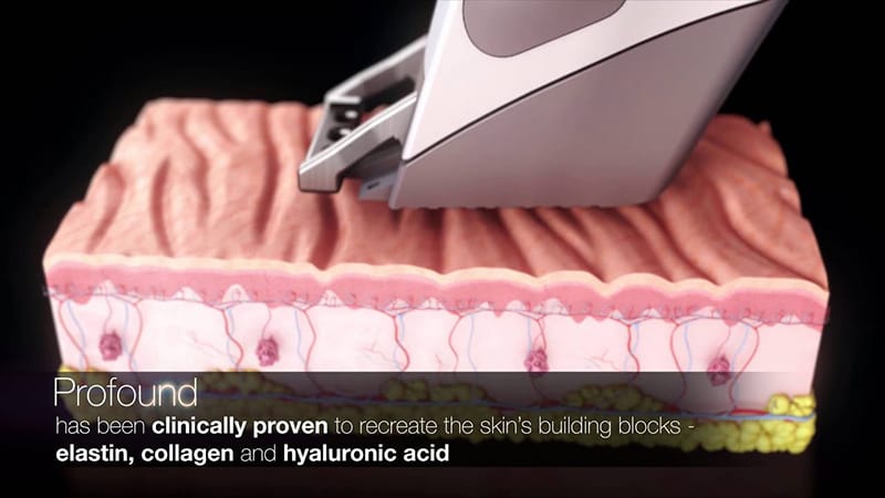 Profound RF Treatment Newport Beach