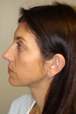Otoplasty Before and After 06 | Sanjay Grover MD FACS