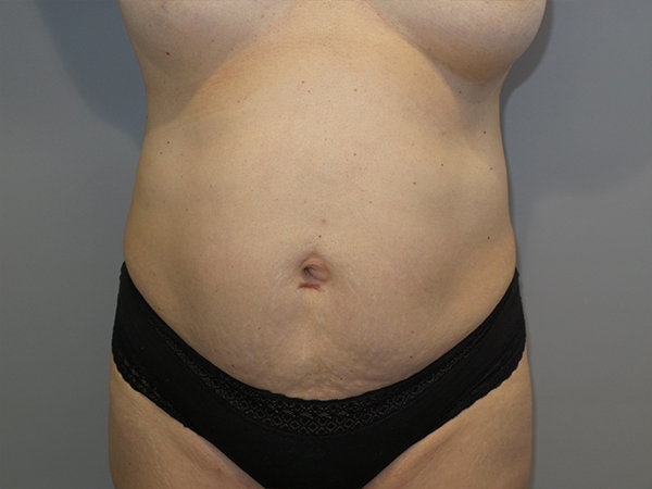 Tummy Tuck Before and After 83 | Sanjay Grover MD FACS