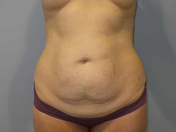 Tummy Tuck Before and After 68 | Sanjay Grover MD FACS